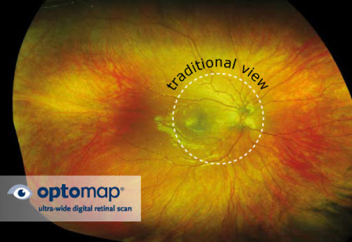Optomap ultra-widefield retinal photograph showing the retina, macula and optic disc in panoramic colour